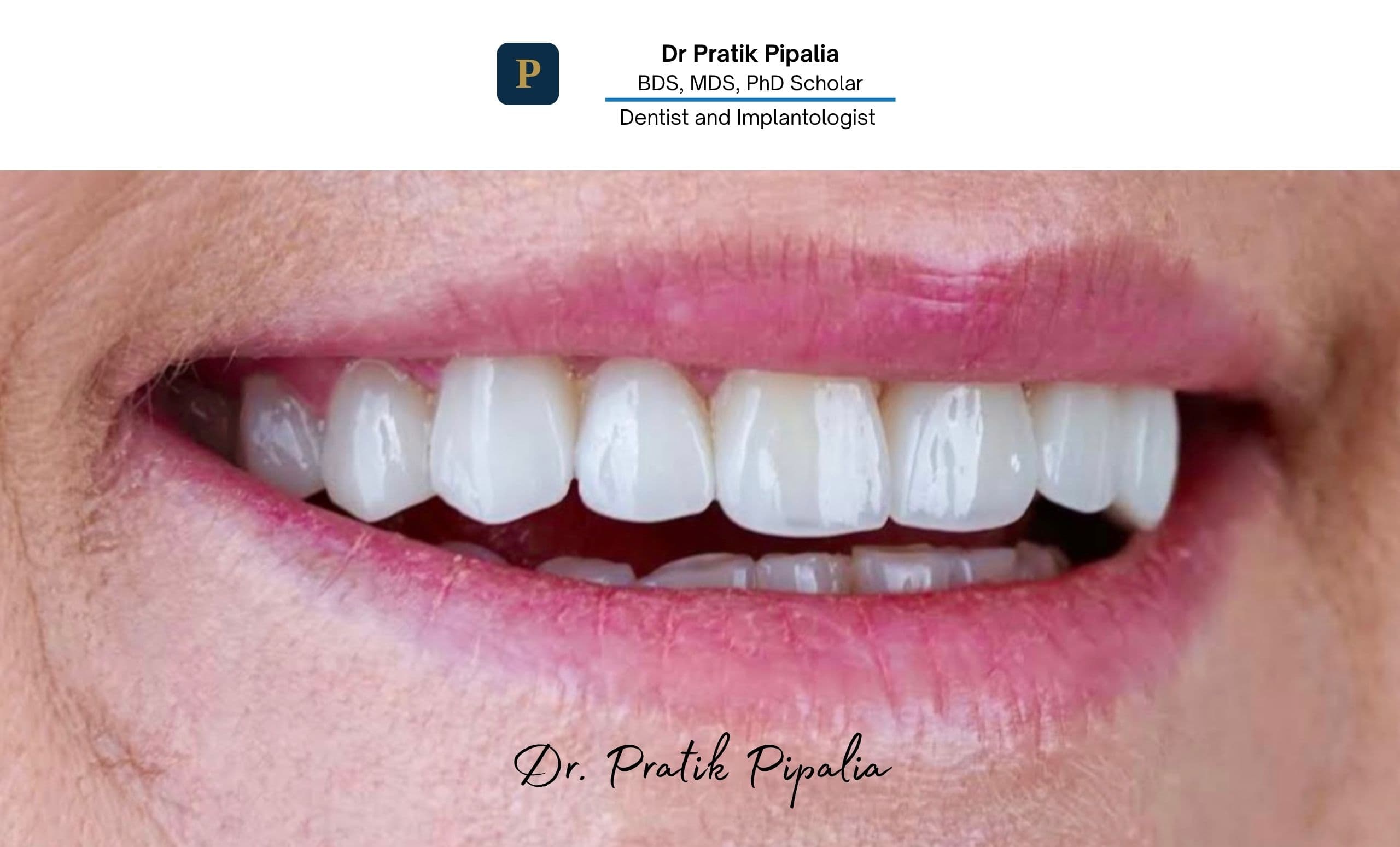 After Invisalign aligner treatment — straighter teeth