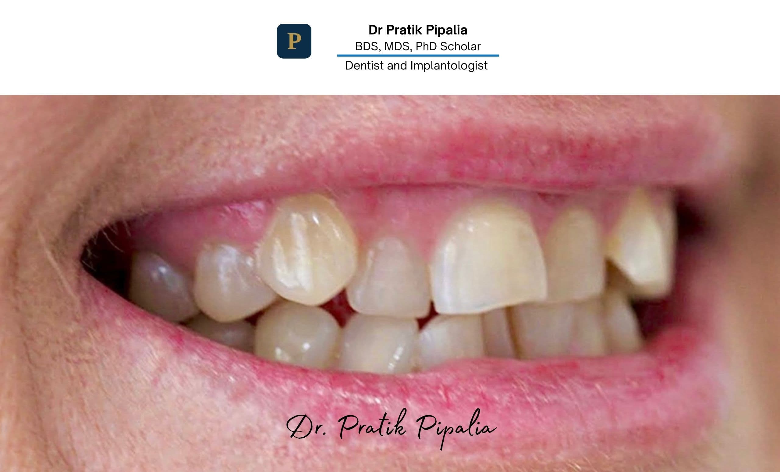 Before Invisalign clear aligner treatment